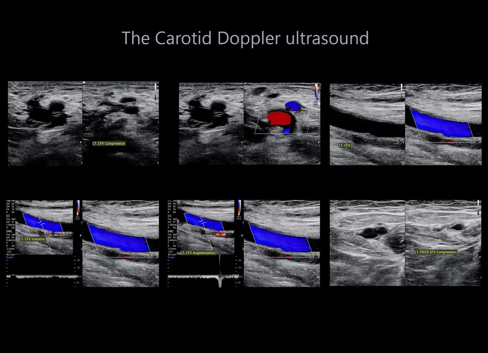 Carotid Arteries Doppler