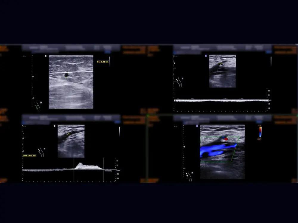 DVT Scan (One side)